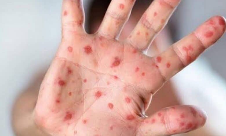 Australians warned to be on high alert for monkeypox symptoms