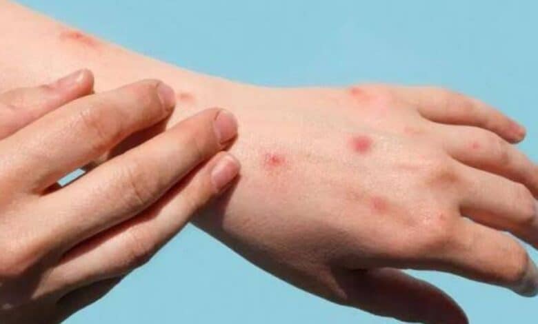 Third in Gulf, Qatar reports first case of monkeypox