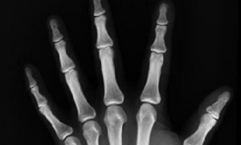 Signs that indicate your bones are weak