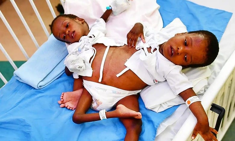 Saudi Arabia: 16-hr-surgery to separate conjoined Tanzanian twins begins