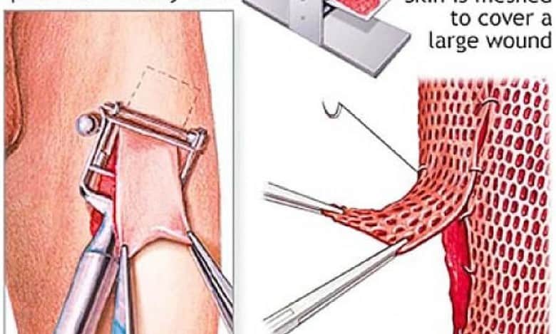 Bengaluru: Skin donation in high demand as people seek treatment for wounds