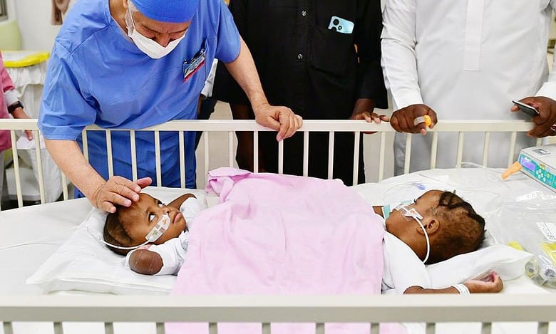 Saudi Arabia begins 14-hr surgery to separate Nigerian conjoined twins
