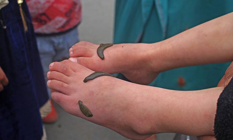 Kashmir: Hundereds undergo leech therapy on Navroz to treat ailments