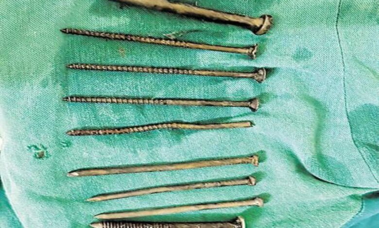 9 nails removed from prisoners stomach at Hyderabad hospital