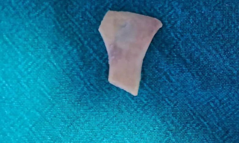 Hyderabad hospital removes mutton bone stuck in esophagus of elderly man