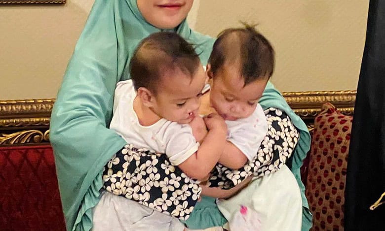 Saudi Arabia begins 7.5 hr surgery to separate conjoined Filipino twins