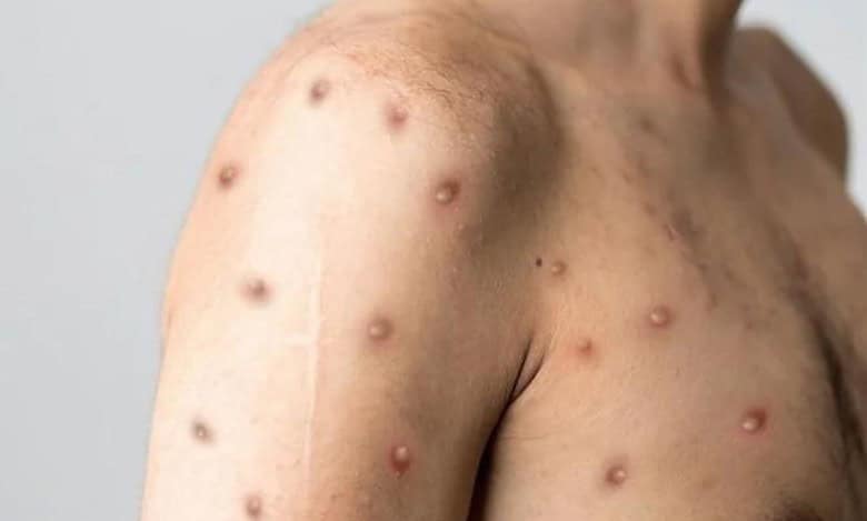 Mpox Rashes
