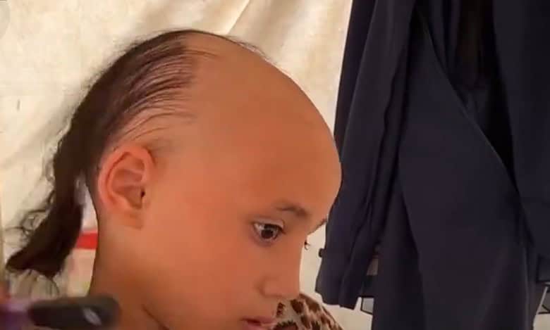 8-yr-old Palestinian girl loses hair due to trauma of war