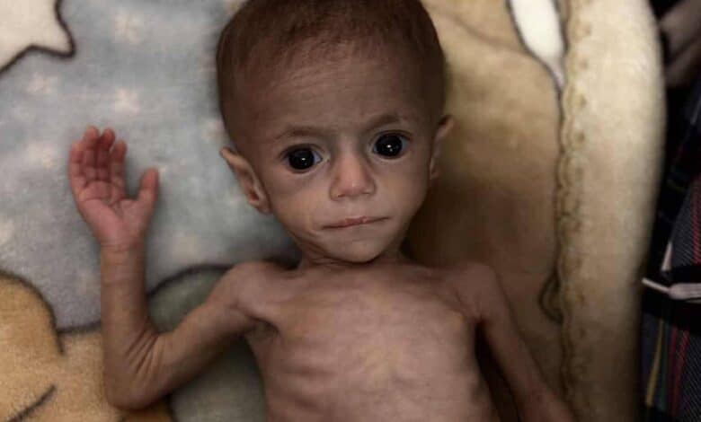 The image of a severely malnourished infant, Siwar Ashour, lies on a patterned blanket, her ribs visibly protruding. Her eyes appear large and sunken, reflecting the impact of prolonged hunger. An adult hand gently supports her arm.