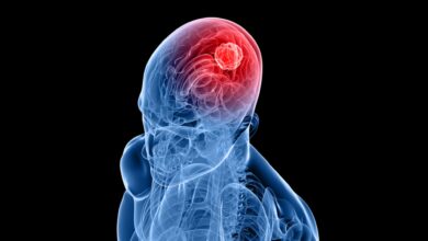 A representational image depicting brain tumour