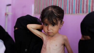 The image of a young girl suffering from acute malnutrition.