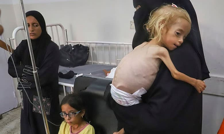 Islam Qudeih holds her severely malnourished shirtless, 2-year-old daughter, Shamm, at Nasser Hospital in Khan Younis, southern Gaza Strip. (Photo | AP)
