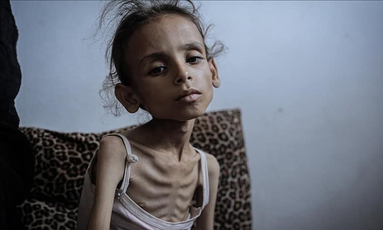 Severely malnourished child sits on a patterned cushion, showing visible signs of starvation.