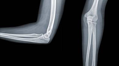 Two elbow x-rays on a black background