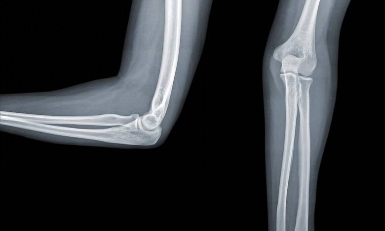 Two elbow x-rays on a black background