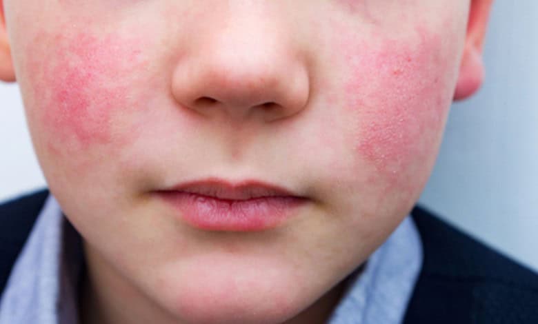 Image showing a child with a rash on his cheeks