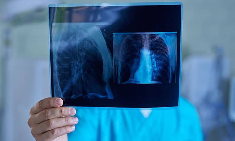 Medical professional examining lung X-ray for signs of lung cancer.